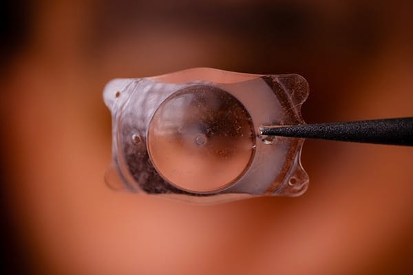 implants phake dr arthus drevon chirurgie ophtalmologique lyon chirurgie refractive chirurgie de la cataracte surface oculaire