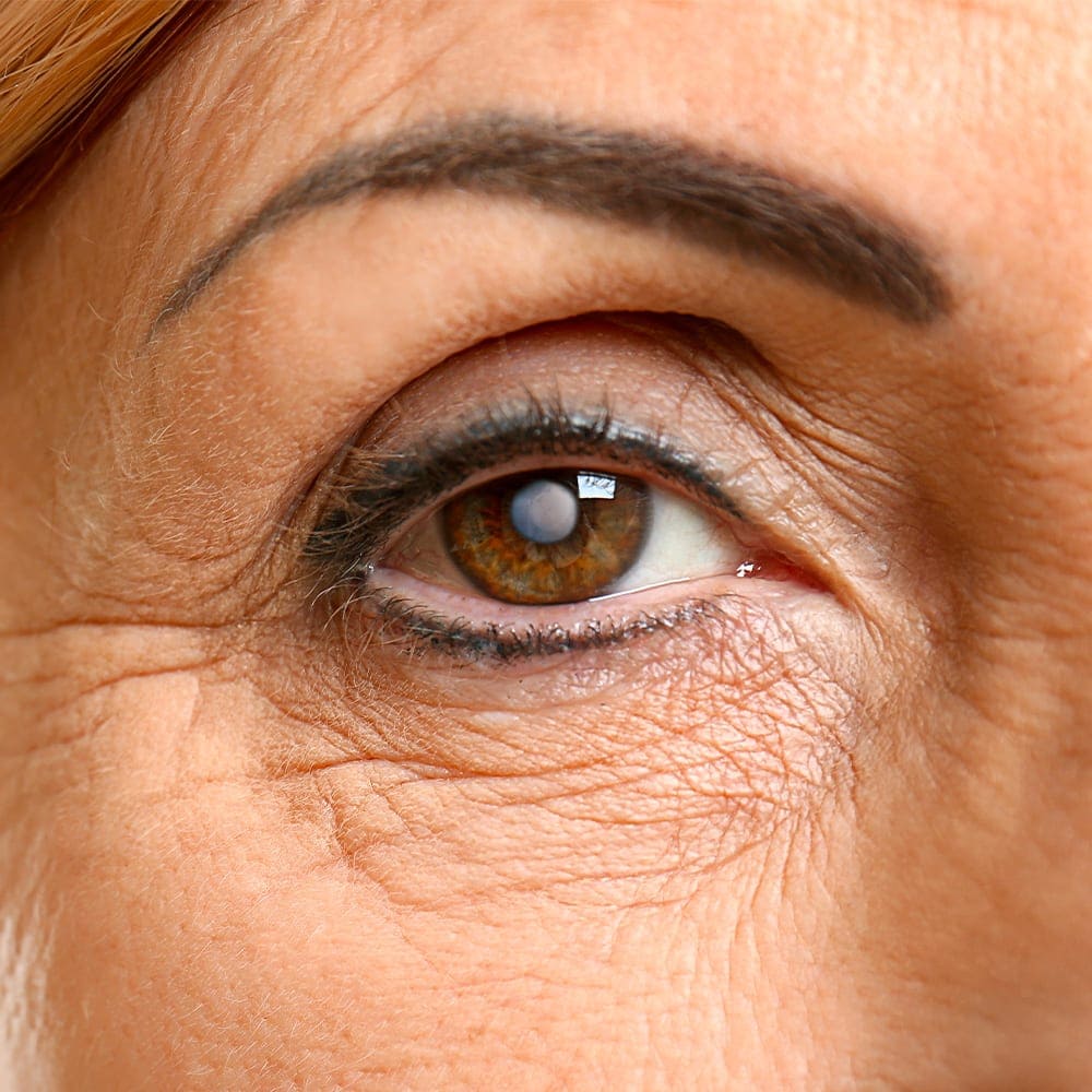 operation cataracte oeil docteur drevon chirurgie ophtalmologique lyon chirurgie refractive chirurgie de la cataracte surface oculaire