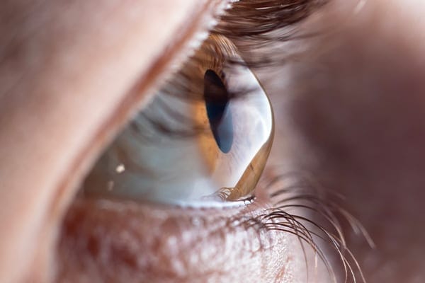 traitement keratocone definition dr arthus drevon chirurgie ophtalmologique lyon chirurgie refractive chirurgie de la cataracte surface oculaire