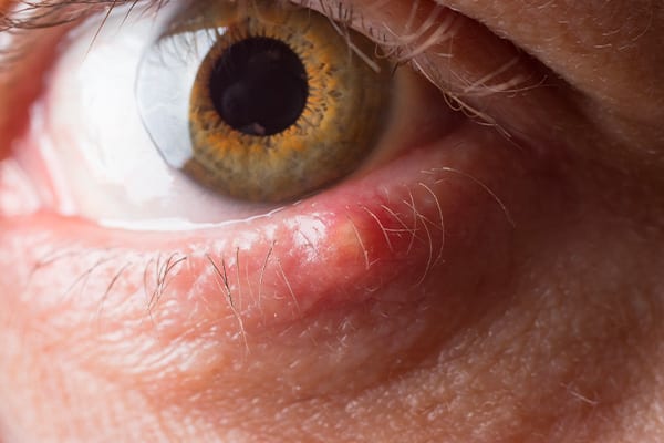 urgences ophtalmologiques autour de moi docteur arthus drevon chirurgie ophtalmologique lyon chirurgie refractive chirurgie de la cataracte surface oculaire