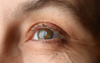 Chirurgie réfractive et cataracte