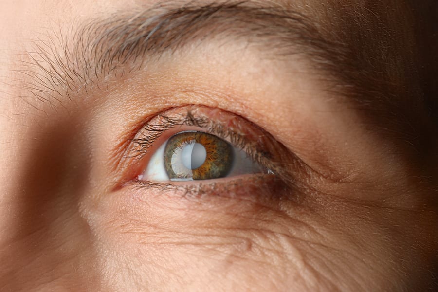 chirurgie refractive cataracte dr arthus drevon chirurgie ophtalmologique lyon chirurgie refractive chirurgie de la cataracte surface oculaire